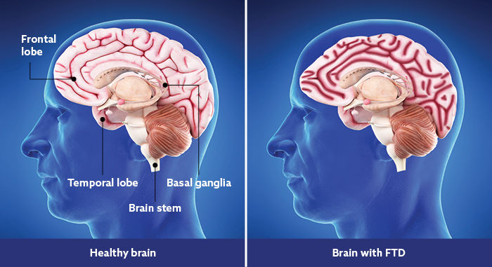 Healthy Brain vs Brain with FTD